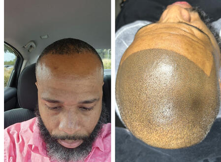 Before and After